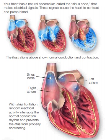 atrial fibrillation or flutter, Florida Cardiology, P.A