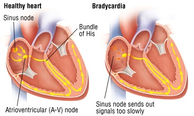 bradycardia, Florida Cardiology, P.A
