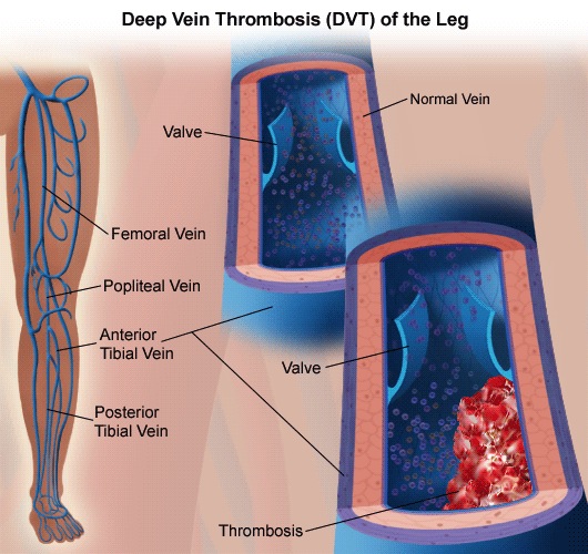 deep venous thrombosis 01, Florida Cardiology, P.A