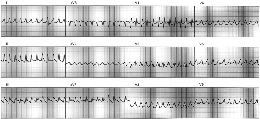 ventricular tachycardia, Florida Cardiology, P.A