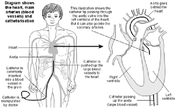 Cardiac Catherization And Coronary Angiography Patient