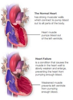 congestive heart failure definition