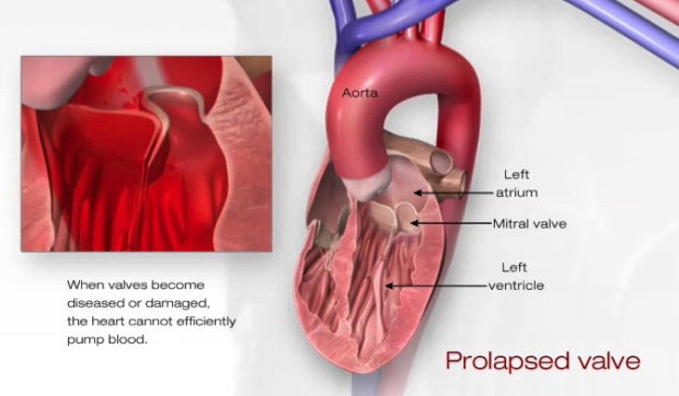 mitral valve prolapse, Florida Cardiology, P.A