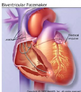 Bi VICD, Florida Cardiology, P.A