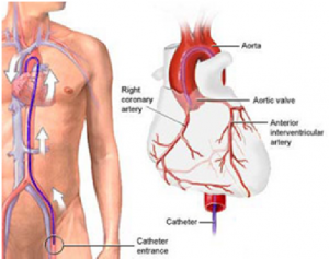 Cardiac Catherization and Coronary, Florida Cardiology, P.A