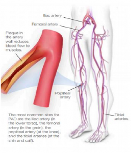 Peripheral Vascular Disease, Florida Cardiology, P.A