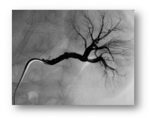 Renal Artery Angiography, Florida Cardiology, P.A