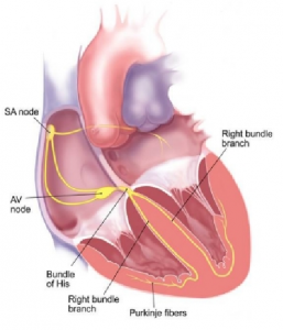 Supraventricular Tachycardia SVT, Florida Cardiology, P.A