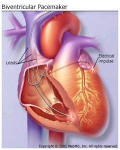 biventricular pacemarker, Florida Cardiology, P.A
